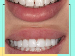 Избавься от щербинок и других несовершенностей быстро и безболезненно в стоматологии «Улыбка» 