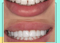 Избавься от щербинок и других несовершенностей быстро и безболезненно в стоматологии "Улыбка" 