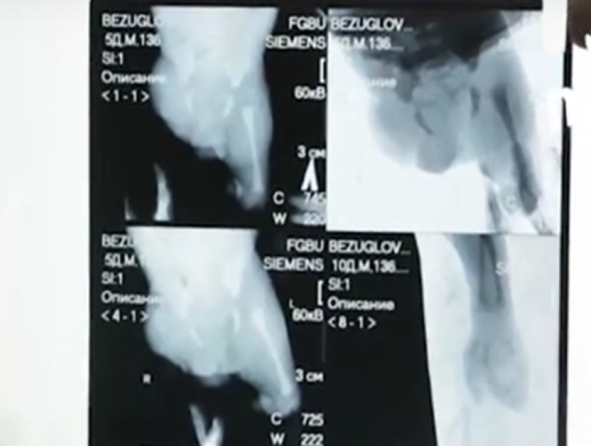 Младенец без ног родился в Морозовске